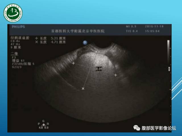 【病例】右侧阔韧带平滑肌瘤脂肪变性1例CT