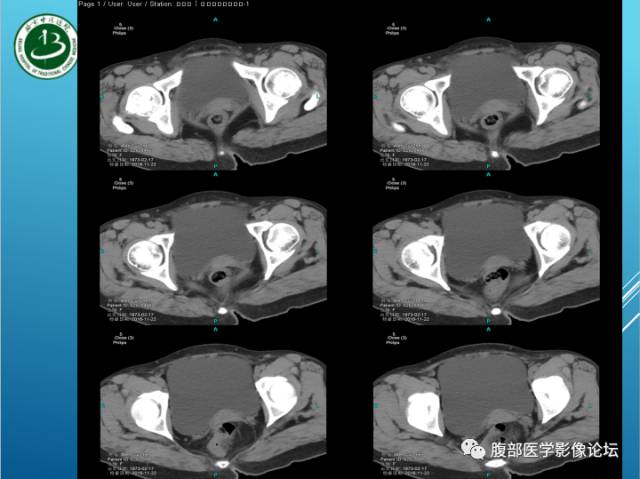 【病例】右侧阔韧带平滑肌瘤脂肪变性1例CT