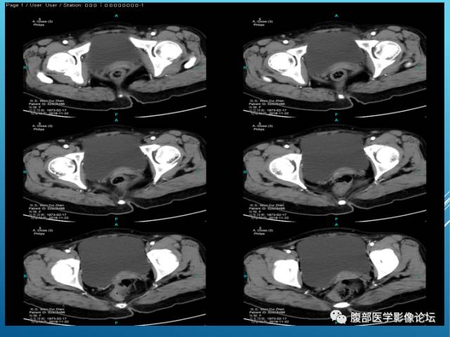 【病例】右侧阔韧带平滑肌瘤脂肪变性1例CT