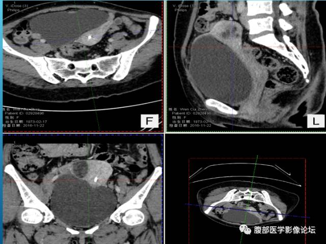 【病例】右侧阔韧带平滑肌瘤脂肪变性1例CT