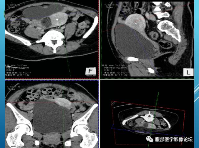 【病例】右侧阔韧带平滑肌瘤脂肪变性1例CT