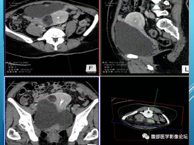 【病例】右侧阔韧带平滑肌瘤脂肪变性1例CT