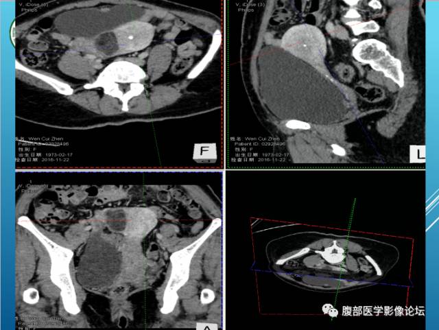 【病例】右侧阔韧带平滑肌瘤脂肪变性1例CT