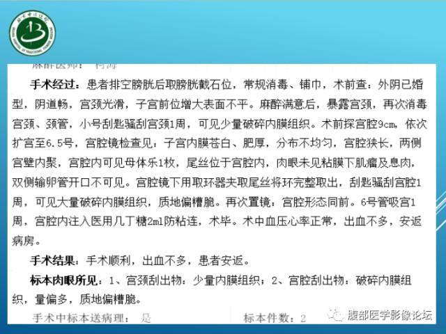 【病例】右侧阔韧带平滑肌瘤脂肪变性1例CT