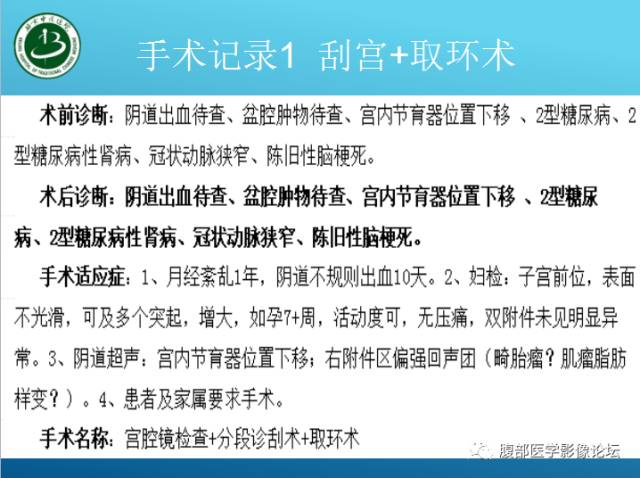 【病例】右侧阔韧带平滑肌瘤脂肪变性1例CT