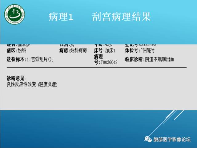 【病例】右侧阔韧带平滑肌瘤脂肪变性1例CT