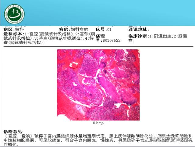 【病例】右侧阔韧带平滑肌瘤脂肪变性1例CT