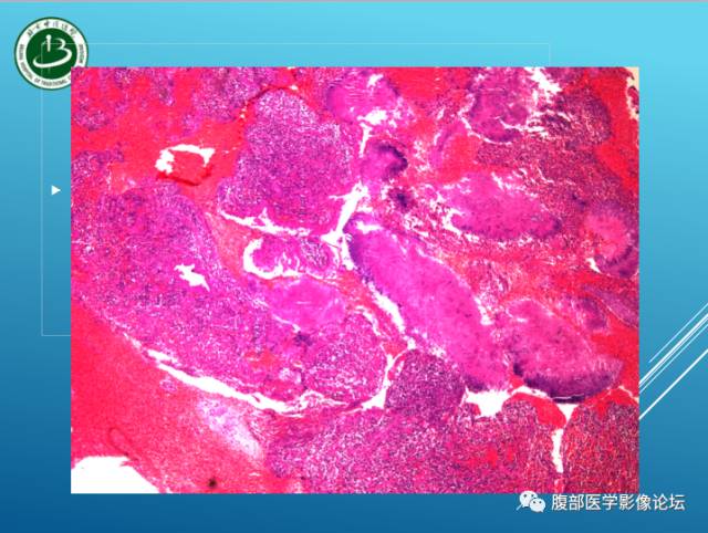 【病例】右侧阔韧带平滑肌瘤脂肪变性1例CT