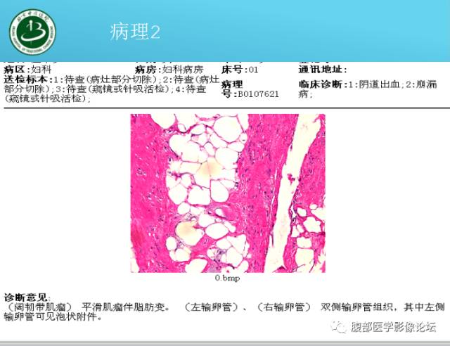 【病例】右侧阔韧带平滑肌瘤脂肪变性1例CT