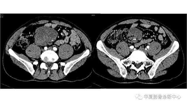 【病例】腹膜后侵袭性纤维瘤病1例CT影像表现