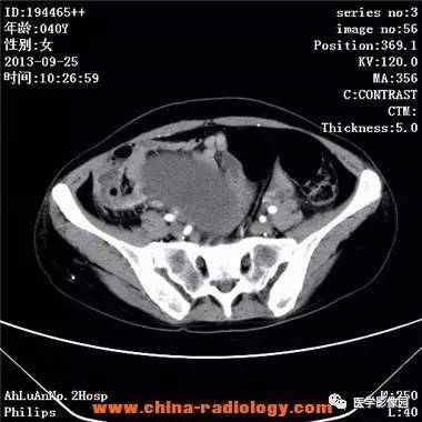 【病例】胃癌伴两侧卵巢库肯勃瘤1例CT影像表现