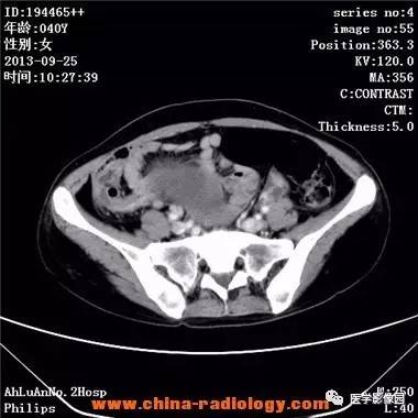 【病例】胃癌伴两侧卵巢库肯勃瘤1例CT影像表现
