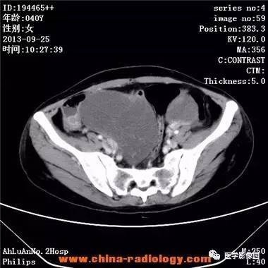 【病例】胃癌伴两侧卵巢库肯勃瘤1例CT影像表现