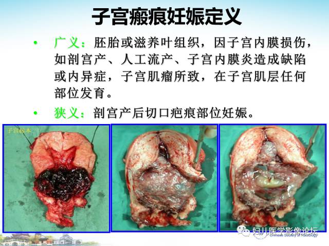 【PPT】剖宫产后子宫切口妊娠的MRI诊断及介入治疗