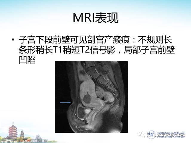 【PPT】剖宫产后子宫切口妊娠的MRI诊断及介入治疗