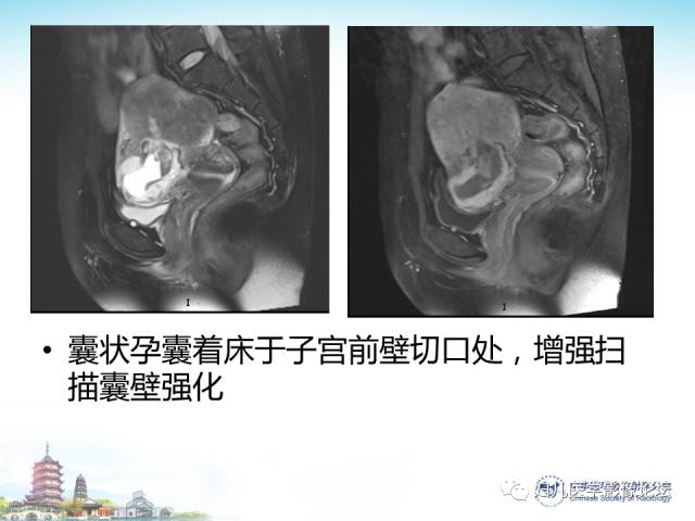 【PPT】剖宫产后子宫切口妊娠的MRI诊断及介入治疗