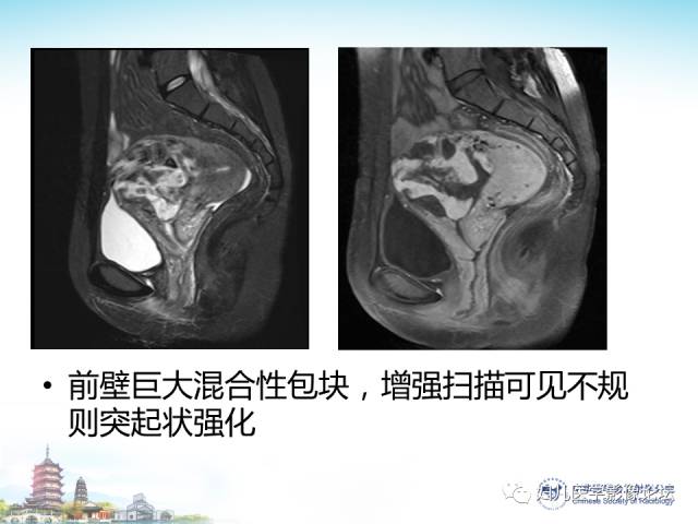 【PPT】剖宫产后子宫切口妊娠的MRI诊断及介入治疗