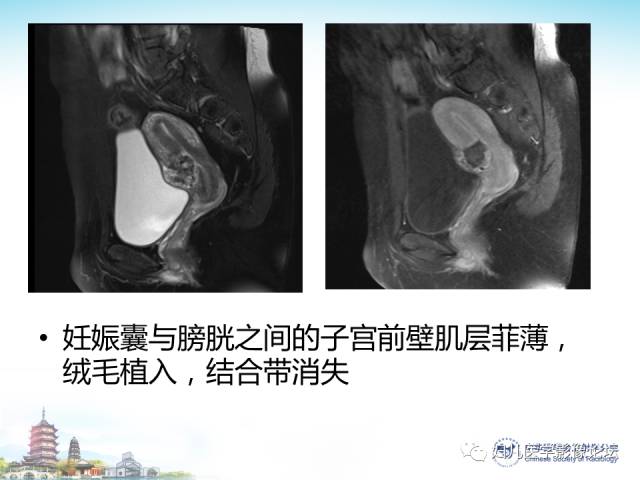 【PPT】剖宫产后子宫切口妊娠的MRI诊断及介入治疗