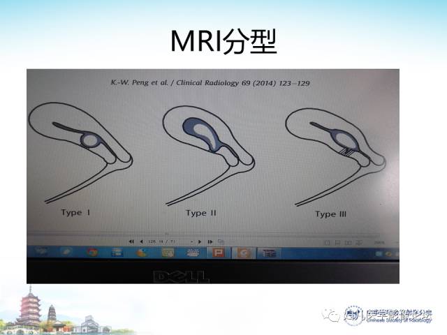 【PPT】剖宫产后子宫切口妊娠的MRI诊断及介入治疗