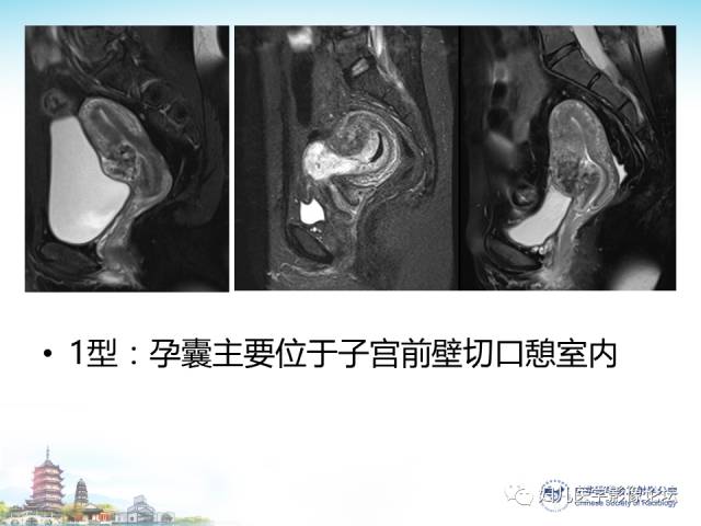 【PPT】剖宫产后子宫切口妊娠的MRI诊断及介入治疗