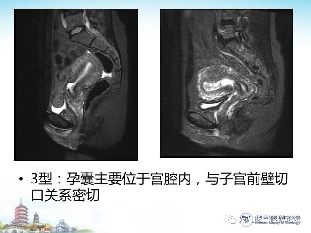 【PPT】剖宫产后子宫切口妊娠的MRI诊断及介入治疗
