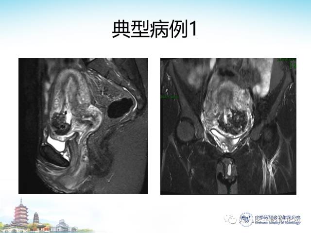 【PPT】剖宫产后子宫切口妊娠的MRI诊断及介入治疗