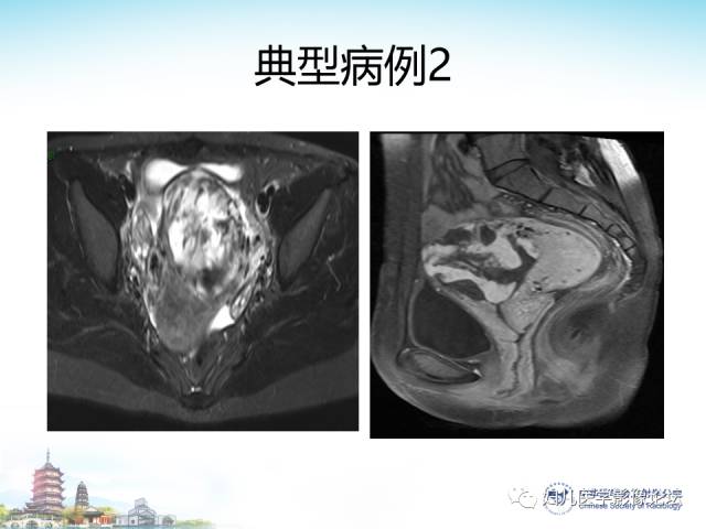【PPT】剖宫产后子宫切口妊娠的MRI诊断及介入治疗