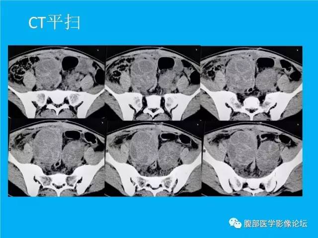 【病例】卵巢过度刺激综合征1例CT影像表现 【病例】卵巢过度刺激综合征1例CT影像表现