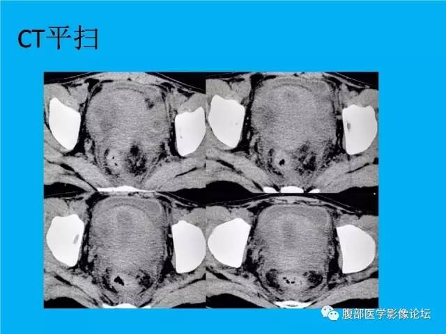 【病例】卵巢过度刺激综合征1例CT影像表现 【病例】卵巢过度刺激综合征1例CT影像表现