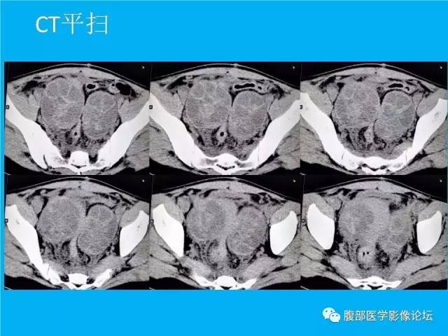 【病例】卵巢过度刺激综合征1例CT影像表现 【病例】卵巢过度刺激综合征1例CT影像表现