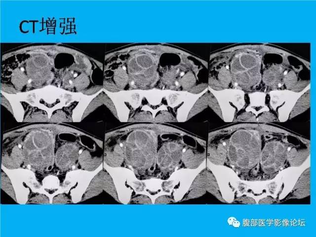【病例】卵巢过度刺激综合征1例CT影像表现 【病例】卵巢过度刺激综合征1例CT影像表现
