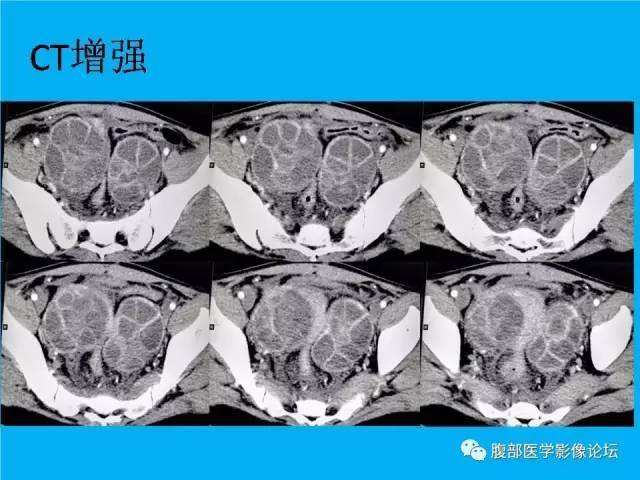 【病例】卵巢过度刺激综合征1例CT影像表现 【病例】卵巢过度刺激综合征1例CT影像表现