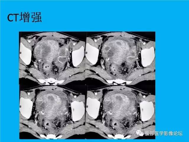 【病例】卵巢过度刺激综合征1例CT影像表现 【病例】卵巢过度刺激综合征1例CT影像表现