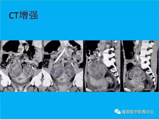 【病例】卵巢过度刺激综合征1例CT影像表现 【病例】卵巢过度刺激综合征1例CT影像表现