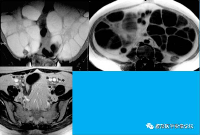 【病例】卵巢过度刺激综合征1例CT影像表现 【病例】卵巢过度刺激综合征1例CT影像表现