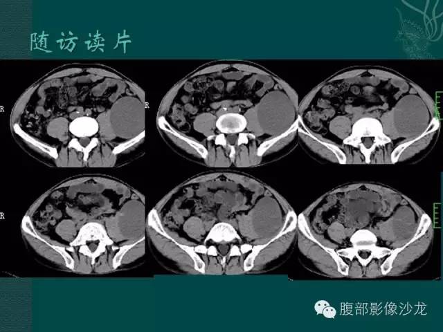【病例】腹膜后神经鞘瘤1例CT影像表现