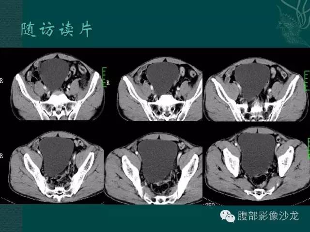 【病例】腹膜后神经鞘瘤1例CT影像表现