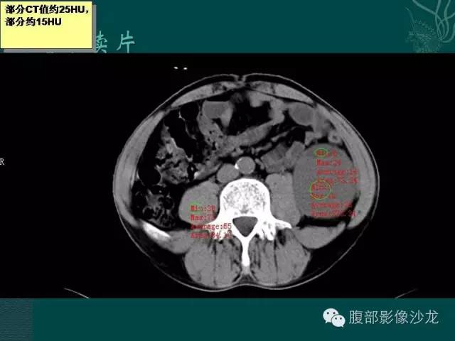【病例】腹膜后神经鞘瘤1例CT影像表现