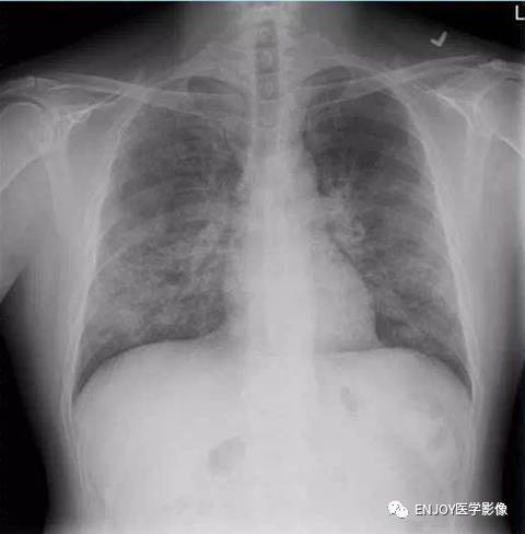 肺泡蛋白沉积症 肺泡蛋白沉积症