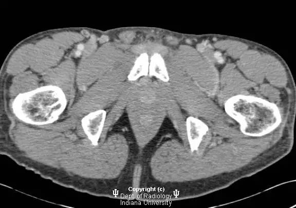 【病例】精索鞘膜积液1例CT影像表现 【病例】精索鞘膜积液1例CT影像表现
