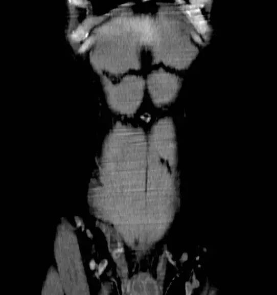 【病例】精索鞘膜积液1例CT影像表现 【病例】精索鞘膜积液1例CT影像表现