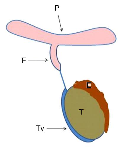 【病例】精索鞘膜积液1例CT影像表现 【病例】精索鞘膜积液1例CT影像表现