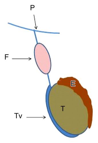 【病例】精索鞘膜积液1例CT影像表现 【病例】精索鞘膜积液1例CT影像表现