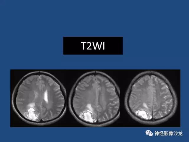 【病例】右顶枕叶髓母细胞瘤一例CT及MR影像讨论 【病例】右顶枕叶髓母细胞瘤一例CT及MR影像讨论