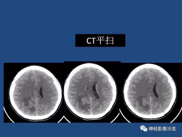 【病例】右顶枕叶髓母细胞瘤一例CT及MR影像讨论 【病例】右顶枕叶髓母细胞瘤一例CT及MR影像讨论