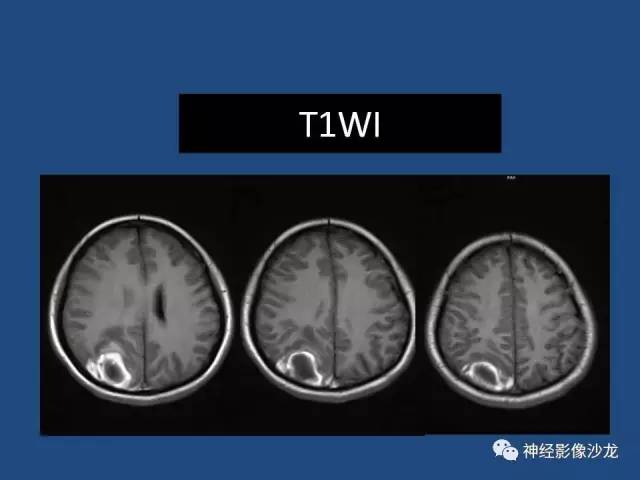 【病例】右顶枕叶髓母细胞瘤一例CT及MR影像讨论 【病例】右顶枕叶髓母细胞瘤一例CT及MR影像讨论