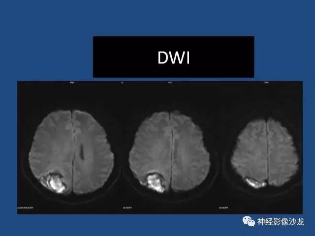 【病例】右顶枕叶髓母细胞瘤一例CT及MR影像讨论 【病例】右顶枕叶髓母细胞瘤一例CT及MR影像讨论