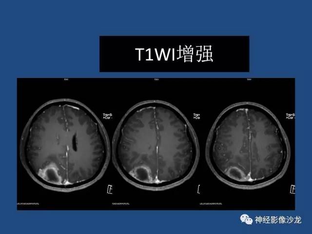 【病例】右顶枕叶髓母细胞瘤一例CT及MR影像讨论 【病例】右顶枕叶髓母细胞瘤一例CT及MR影像讨论