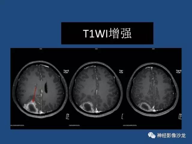 【病例】右顶枕叶髓母细胞瘤一例CT及MR影像讨论 【病例】右顶枕叶髓母细胞瘤一例CT及MR影像讨论