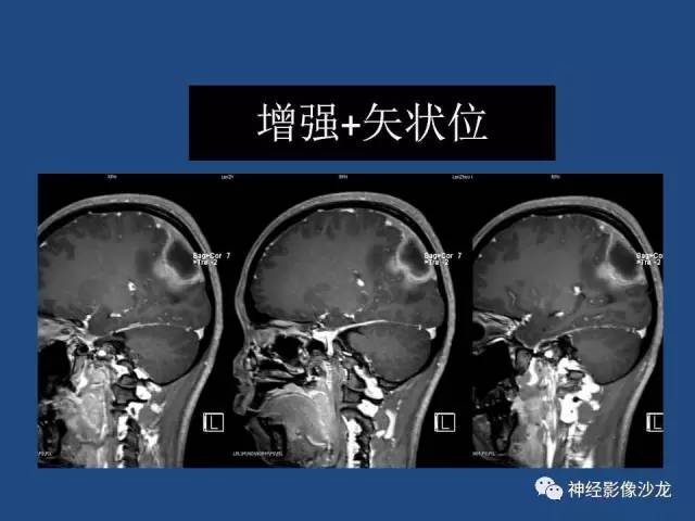 【病例】右顶枕叶髓母细胞瘤一例CT及MR影像讨论 【病例】右顶枕叶髓母细胞瘤一例CT及MR影像讨论